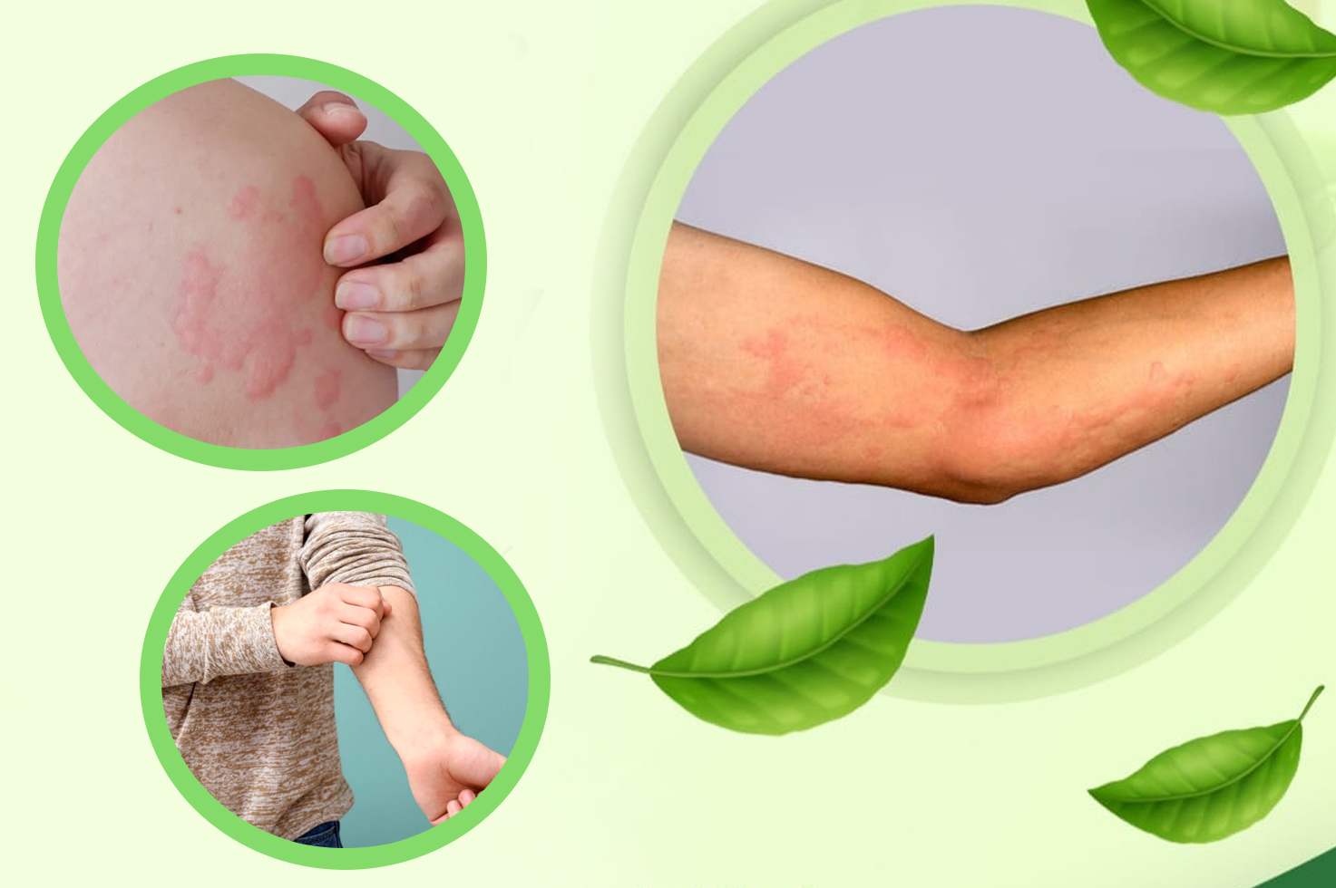What are the of causes hives? | What are the symptoms of hives? | How long do hives last? | When to seek medical treatment for hives? | How are the hives treated and cured? | Various pictures of hives | diseases that cause hives in adults male and female | what are the Causes of hives in female adults | Can hives be a sign of something serious diseases |Various treatment of hives | How to cure hives fast and quick | Pictures of hives rash on legs and hand